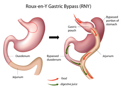 ROUX EN Y GASTRIC BYPASS