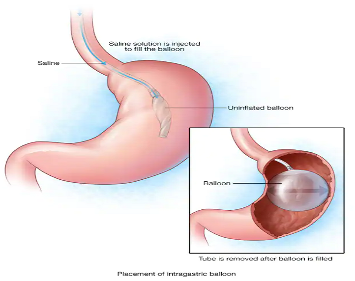 INTRA GASTRIC BALOON
